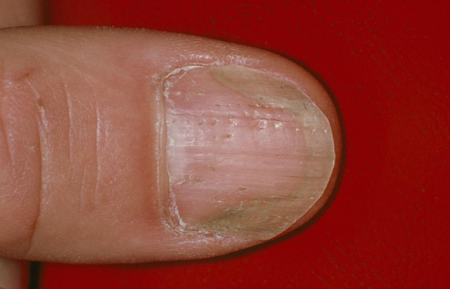 Nail Fungus