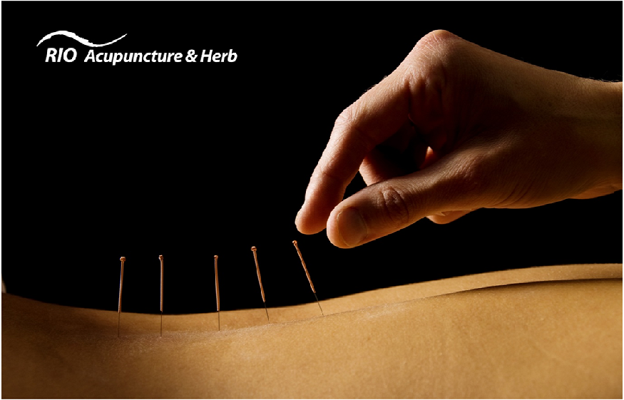 Acupuncture