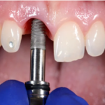 Why Dental Implants Are the Gold Standard in Tooth Replacement?