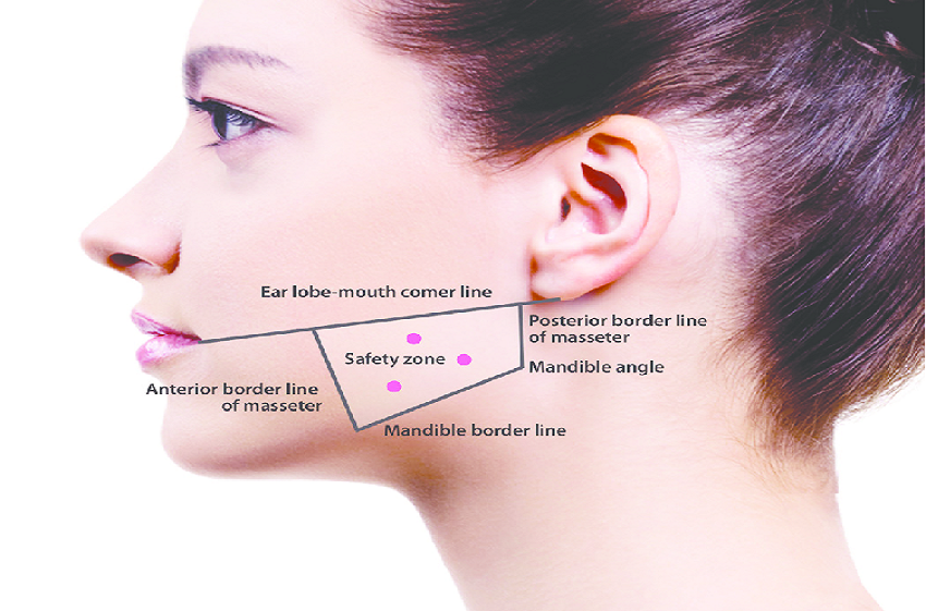 Botox for Jawline Slimming