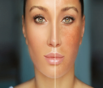 Reduce Melanin in Skin
