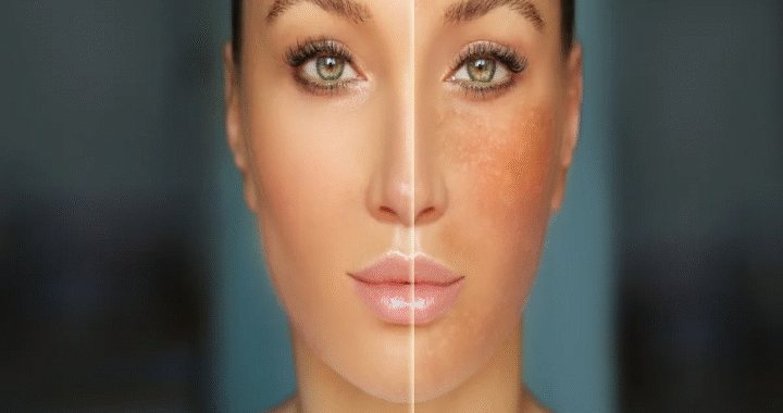 Reduce Melanin in Skin