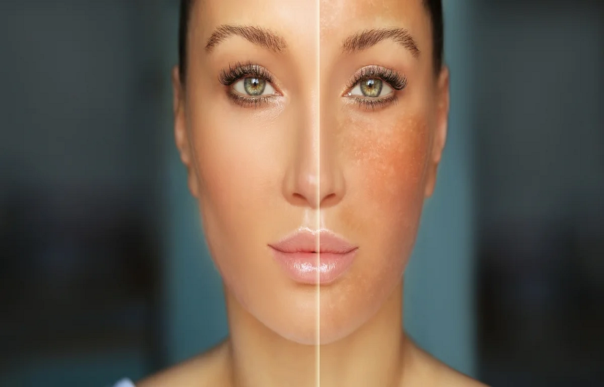 Reduce Melanin in Skin