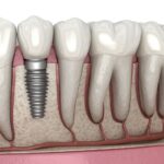 The Step by Step Process of Getting Dental Implants in Fargo