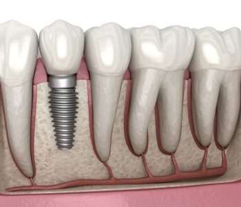 dental implants