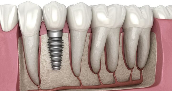 dental implants