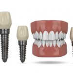Dental Implants and Osteoporosis: What Patients Should Know About Safety and Healing