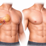 Gynecomastia Surgery Recovery Week by Week: Work, Driving, Sleep and the Gym
