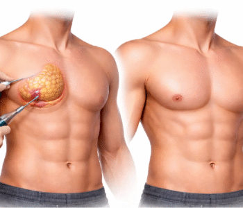 gynecomastia surgery