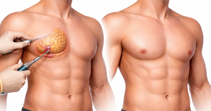 gynecomastia surgery