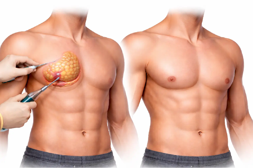 gynecomastia surgery